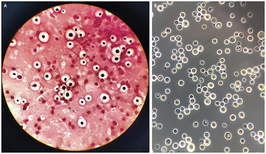 Análisis de La Producción de IL-10 E IFN y de Anticuerpos Igg en Ratones Susceptibles y Resistentes a la Infección por Cryptococcus Neoformans