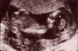Diagnóstico Prenatal -  Desarrollo del polo cefálico