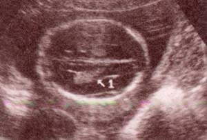 Diagnóstico Prenatal -  Cortes pronto-occipitales normales