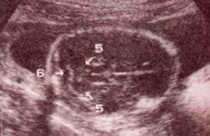 Diagnóstico Prenatal -  Cortes pronto-occipitales normales