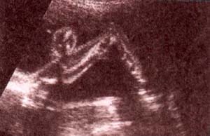 Diagnóstico Prenatal - aspectos normales de piernas y pies