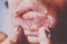 Candidiasis mucocutánea crónica