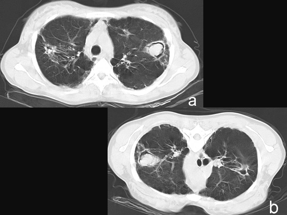 Broncoscopia, Aspergiloma
