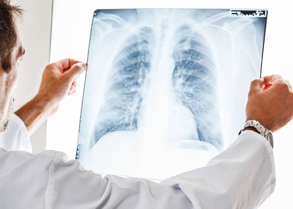 Nódulo pulmonar