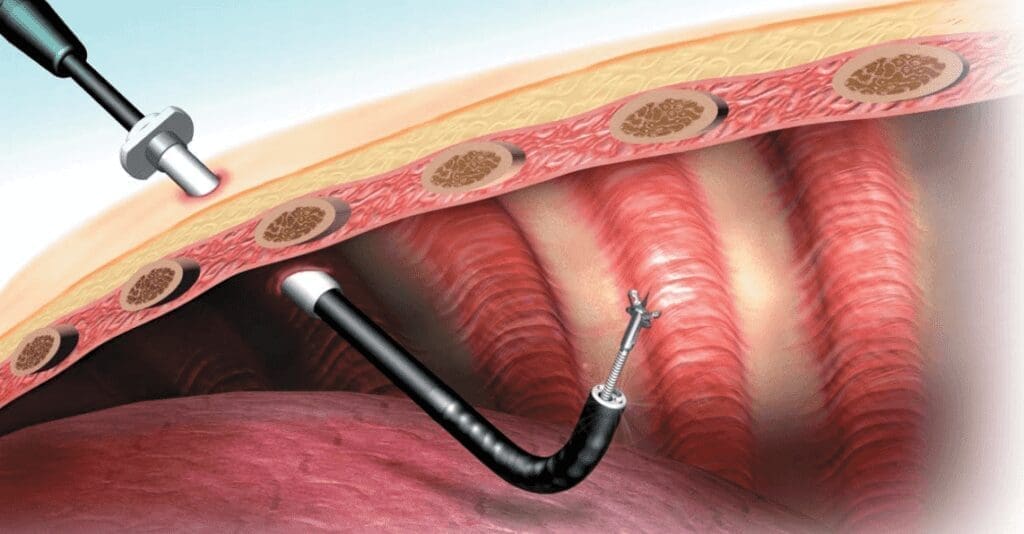La toracoscopia en el manejo de la patología tímica
