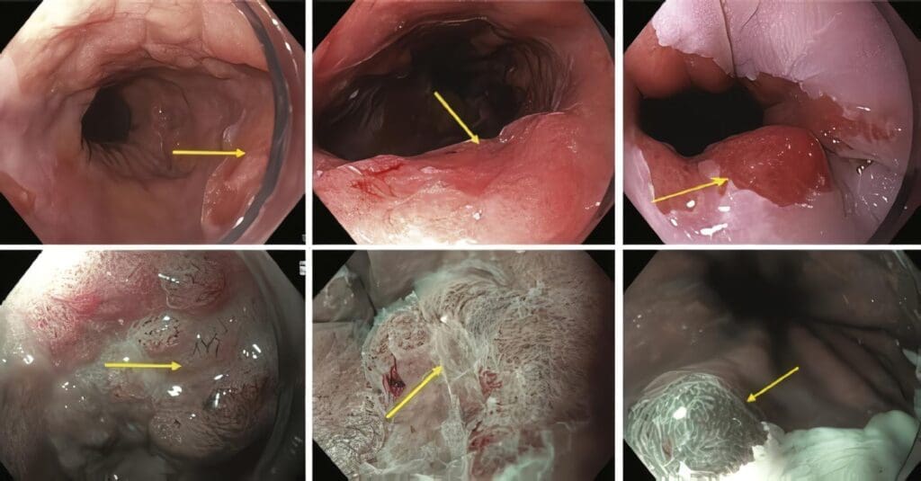 Asociación Colombiana de Endoscopia Digestiva: Cromoendoscopia