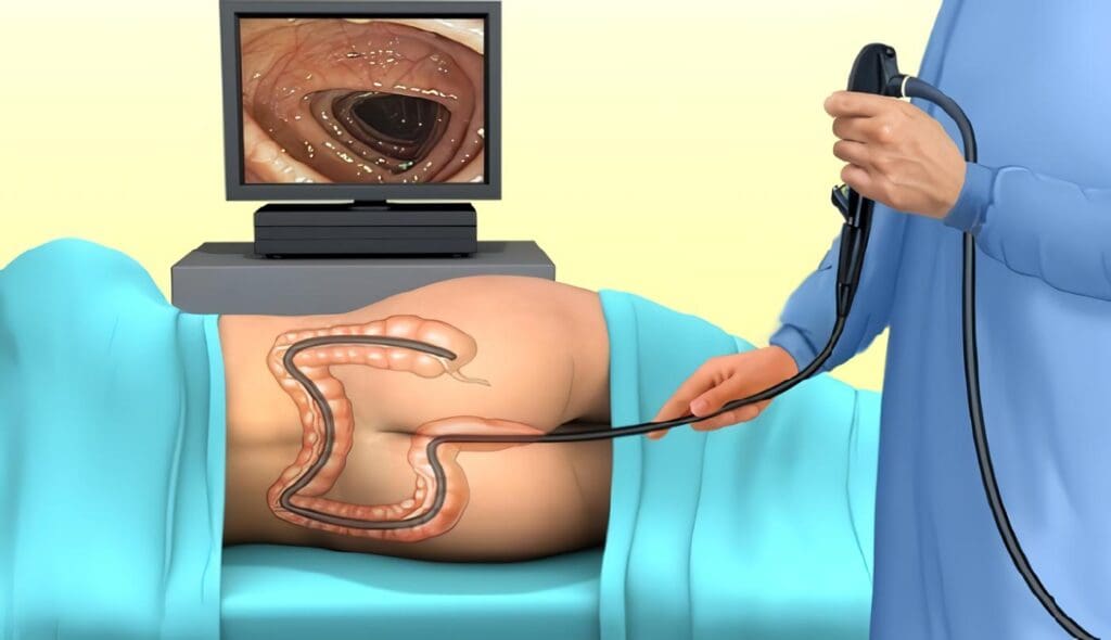 Concepto de Rectosigmoidoscopia