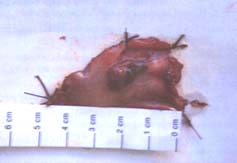 Melanoma del canal anal en mujer de 61 años