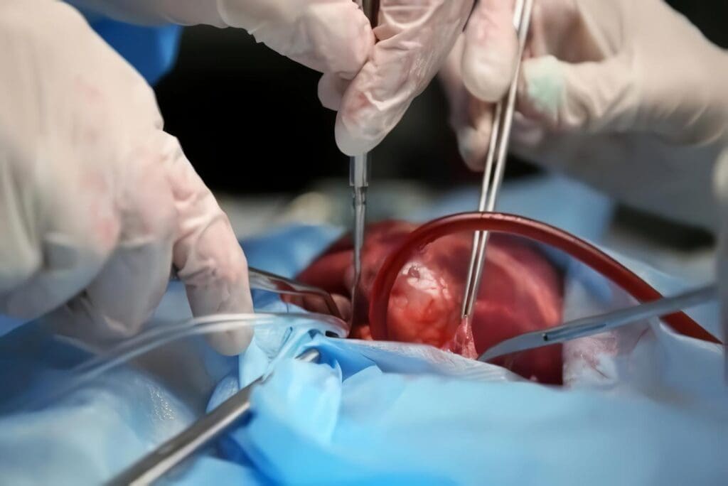 Operación a través de Esternotomía (mediana o transversa)