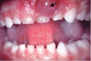 Un Estudio a Corto Plazo de Anticuerpos Monoclonales Quimericos (Ca2)