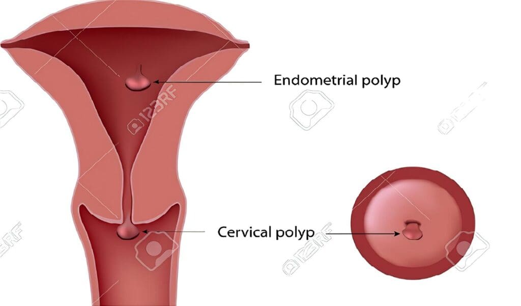 Pólipos Cervicales y Endometriales