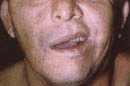 Foto preoperatoria en sonrisa involuntaria
