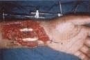 Defecto palmar, Cirugía Plástica