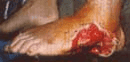 Preoperatoria del defecto lateral del pie