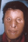 Postoperatoria del paciente.