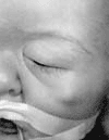 Sindrome de Apert Sindrome de Apert