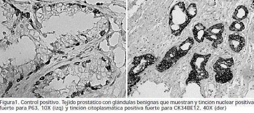 Tejido prostático con glándulas benignas