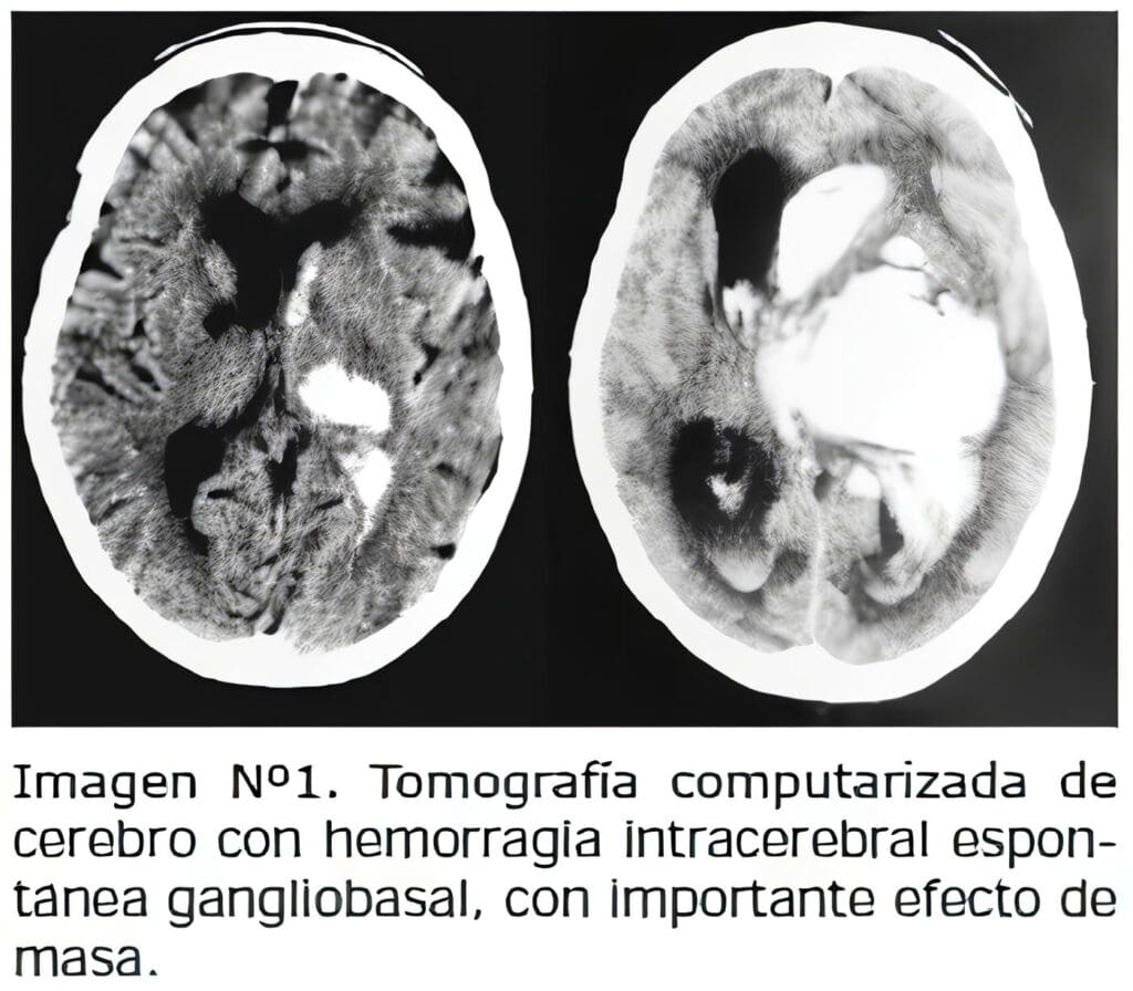 Hemorragia Intracerebral Espontánea: Cuadro Clínico