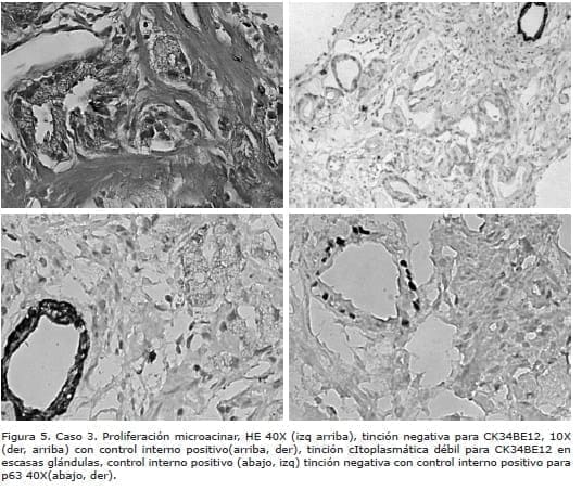 Proliferación microacinar