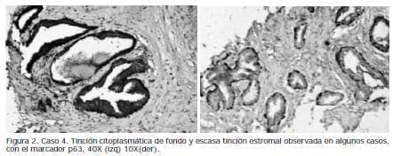 Tinción citoplasmática de fondo y escasa tinción estromal, Caso tinción, Biopsias de Próstata