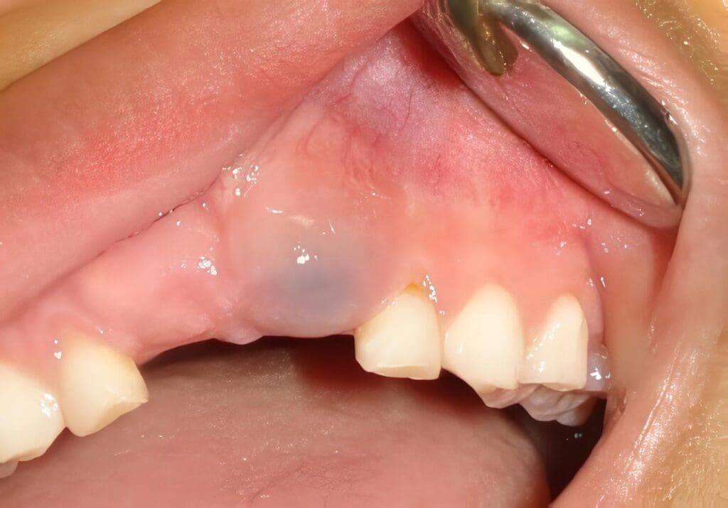 Marsupializacion de Quistes Odontogenicos