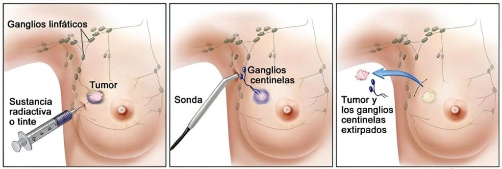 Base de Datos ayuda a evaluar el Riesgo de Cáncer de Mama