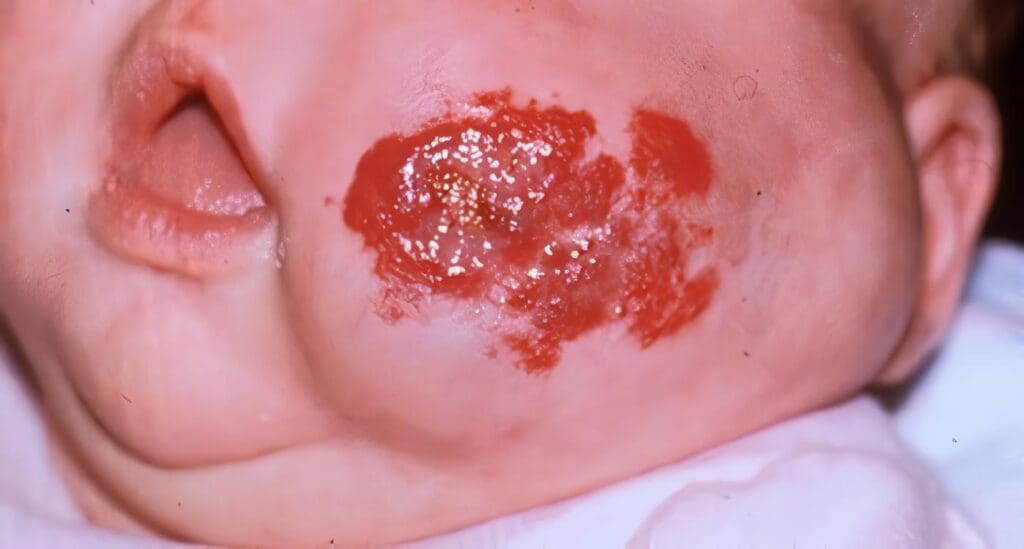 Peso Bajo al Nacer y el Aumento de Hemangiomas Infantiles