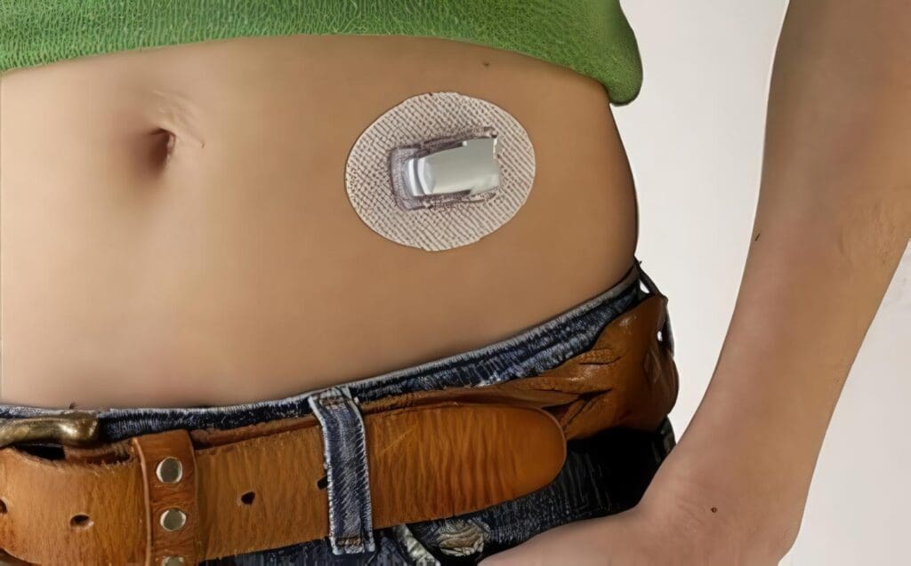 Monitor Subcutáneo de Glucemia mejora el Control de la Diabetes
