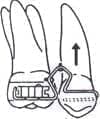 Tecnica de Wilson con Aparatología Fija/Remobible ejemplo6