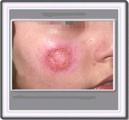 Pediatria_LEISHMANIASIS