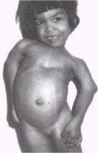 Sindrome_Larsen