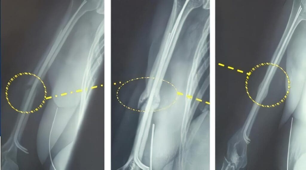 Una Manera de Soldar Fracturas más Rápidamente