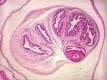 Cisticercosis