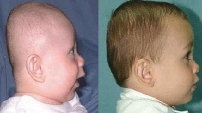 Están Aumentando los Casos de Bebés con Cabeza Plana