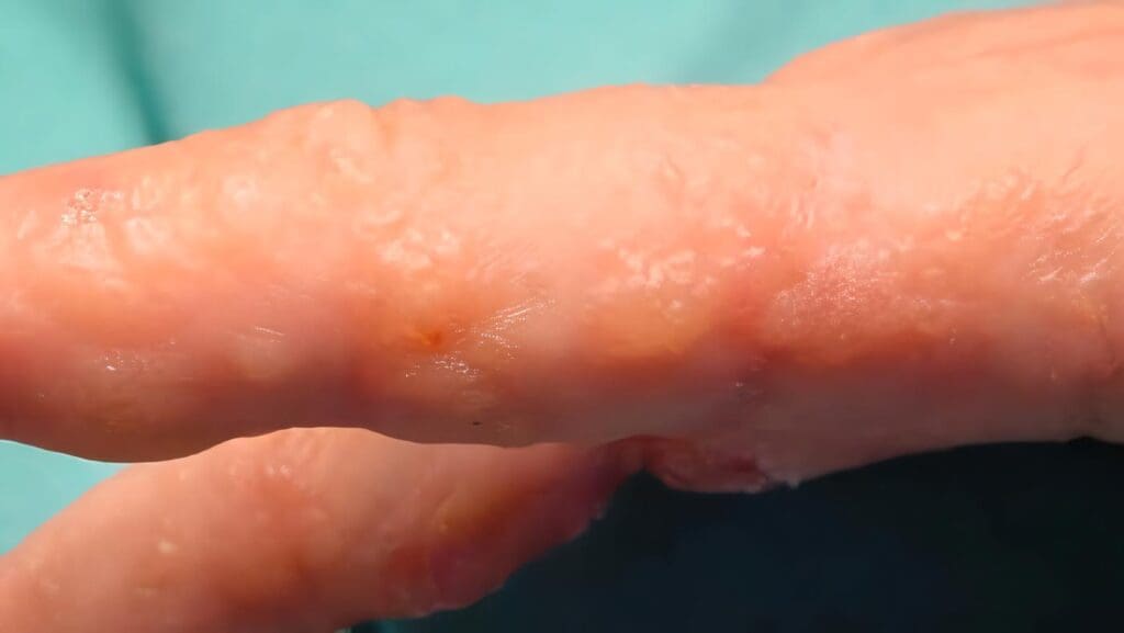 ¿Cómo se Tratan las Dermatofitosis?