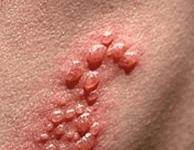 Herpes Genital se Puede Contagiar aún si no hay Lesiones Presentes