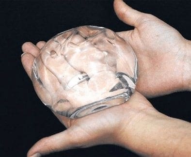 Relación entre los Implantes de Mama y el Linfoma