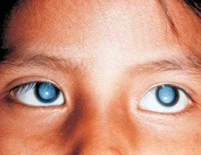 Información Incorrecta sobre las Cataratas