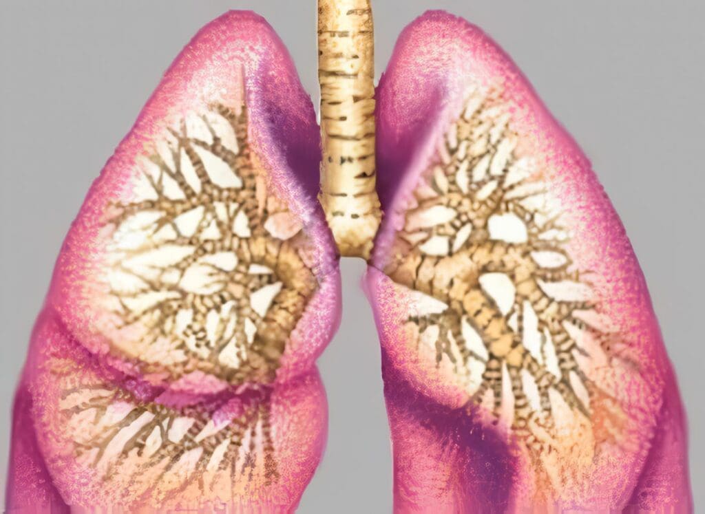 Relacionan Mala Función Pulmonar con Insuficiencia Cardiaca