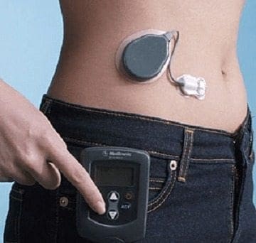Páncreas Artificiales reducen el Riesgo de Hipoglucemia