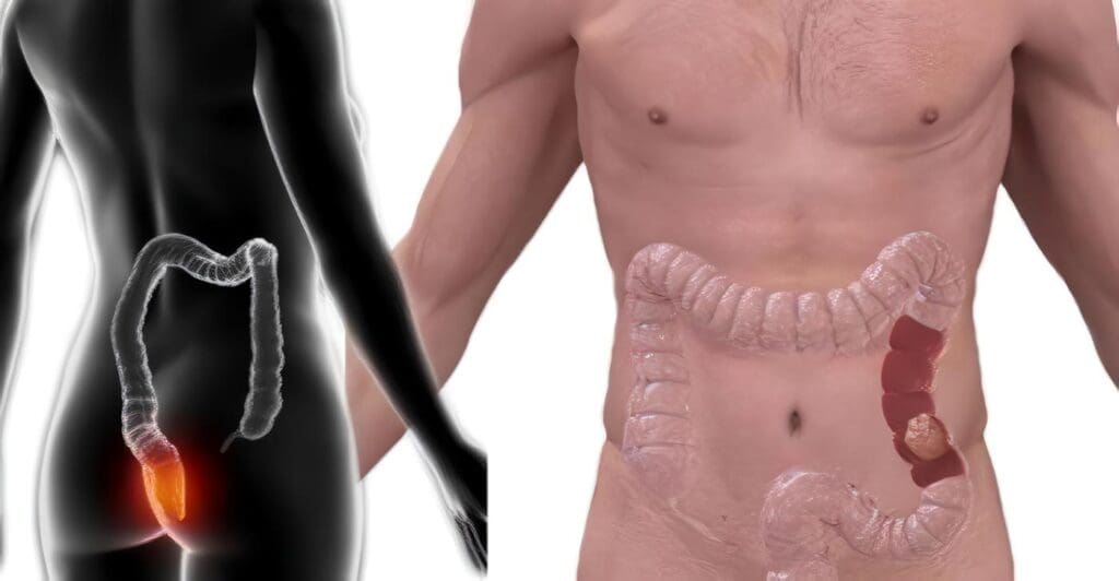 Prueba Isiotópica para Detectar Perforación Intestinal