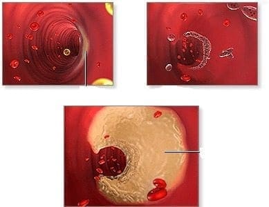 Placa Arterial se Forma en un Corto Periodo de Tiempo