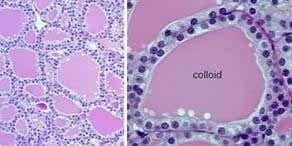 carcinoma papilar