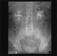 tensiometro9-fig1