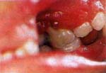 Perdida de Inserción Gingival - Lesiones Periodontales