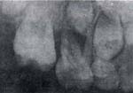 Periapical del Segundo Molar - Lesiones Periodontales