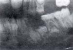 Compromiso Óseo Primer Premolar- Lesiones Periodontales