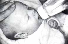 Niña de dos meses con mioclono palatofaríngeo