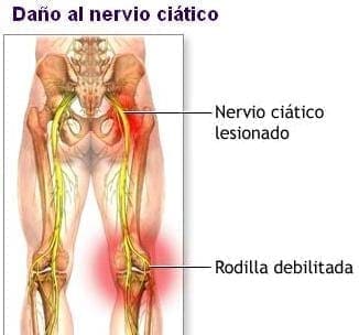 Daño del nervio ciático Daño del nervio ciático