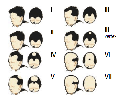 Alopecia masculina Alopecia masculina